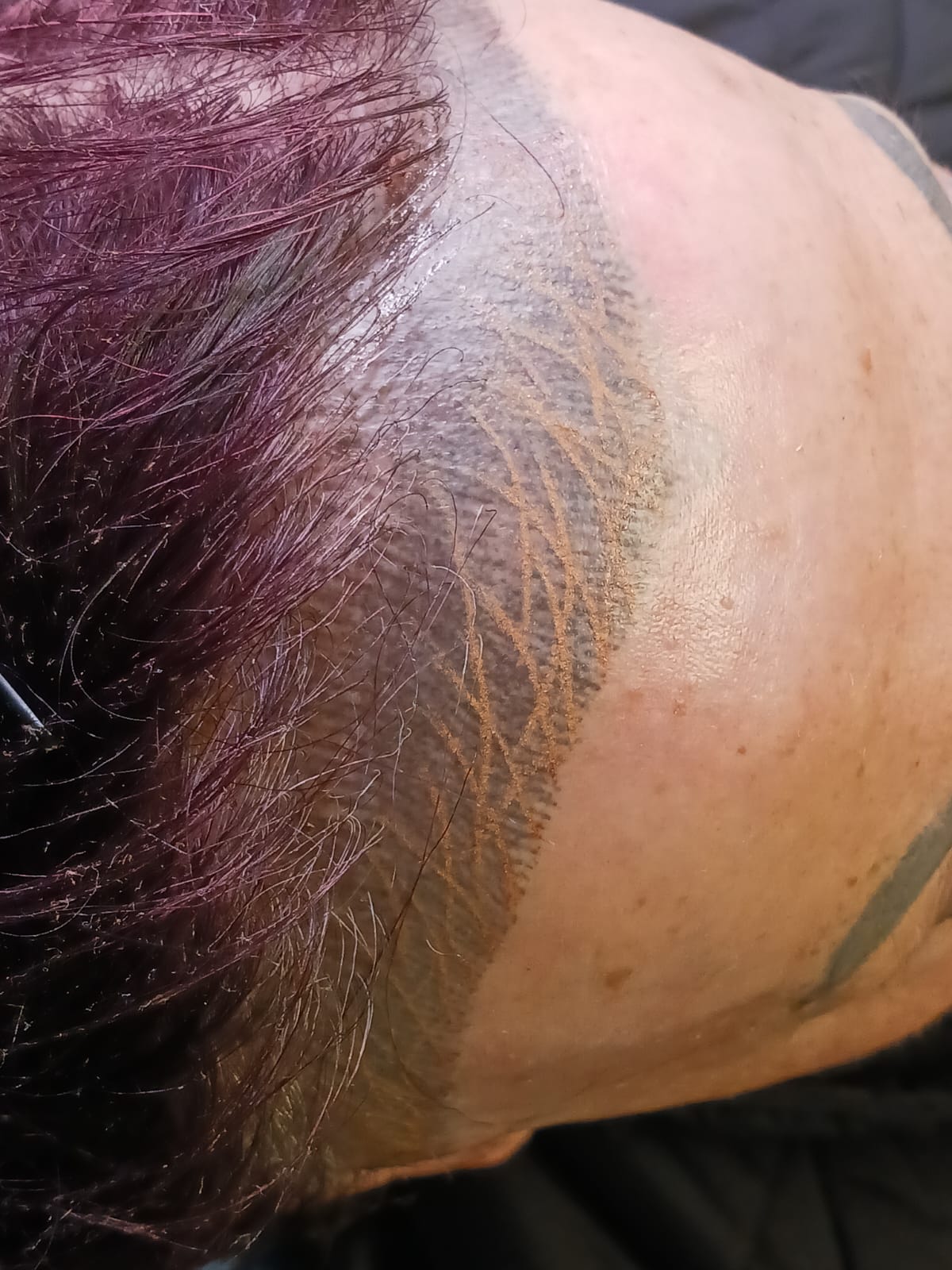 Scalp Micropigmentation for Scarring Alopecia - Permanent Cosmetics - Ormond Beach, Florida Scalp Micropigmentation for Scarring Alopecia - Permanent Cosmetics - Ormond Beach, Florida