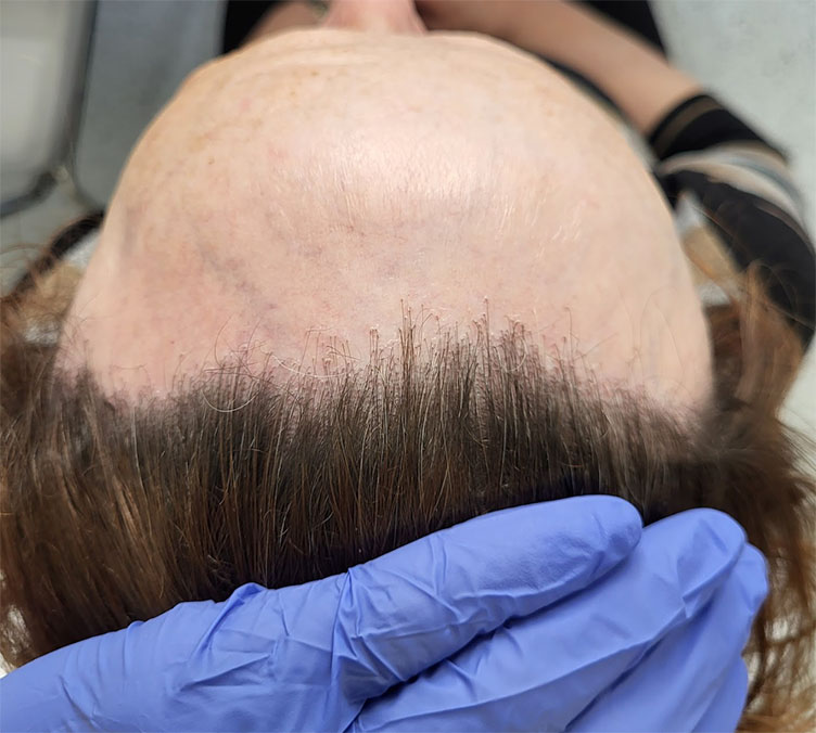Scalp Micropigmentation for Scarring Alopecia Scalp Micropigmentation for Scarring Alopecia
